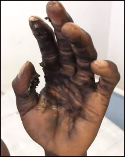 Tangan pekerja dengan kelecuran teruk di lokasi tangan, jari dan ibu jari.