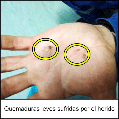 Quemaduras leves sufridas por el herido