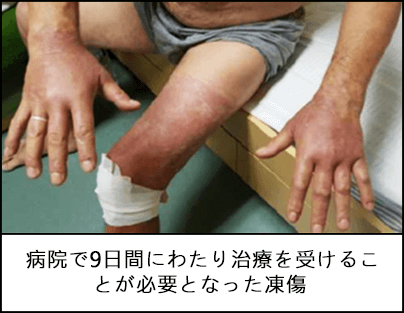 両手と片脚に凍傷を負った作業員。火傷で皮膚が赤くなり、膝には包帯が巻かれている 