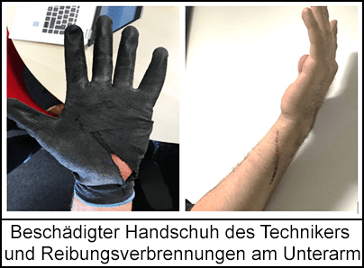 Beschädigter Handschuh des Technikers und Reibungsverbrennungen am Unterarm