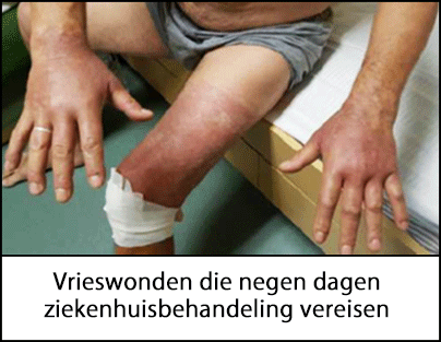 Een medewerker met vrieswonden aan beide handen en een been, met rode huid van de brandwond en een verband rond de knie 