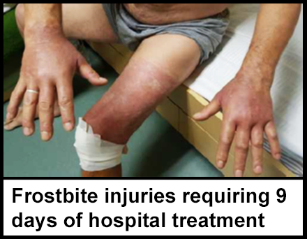 A worker with frostbite injuries on both their hands and one leg, with reddened skin from the burn and a bandage around their knee. 