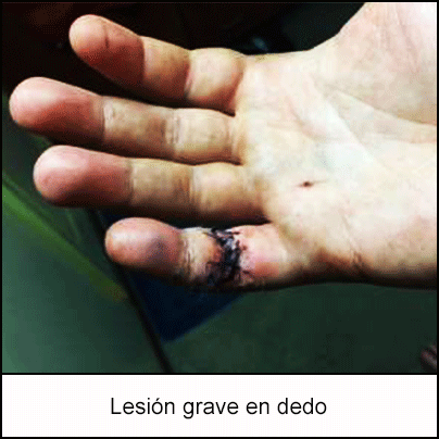 Lesión grave en dedo