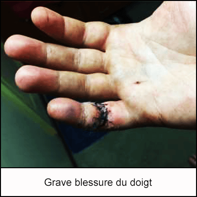 Grave blessure du doigt