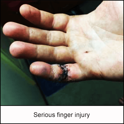 Serious finger injury