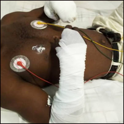 El trabajador lesionado en la cama de la clínica. Los brazos y manos vendados del trabajador, con monitores adheridos al pecho.
