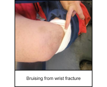 Bruising from wrist fracture