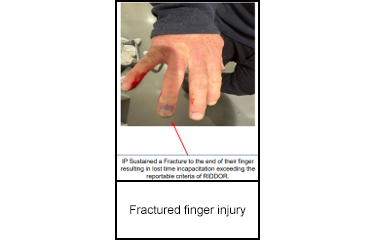 Fractured finger injury