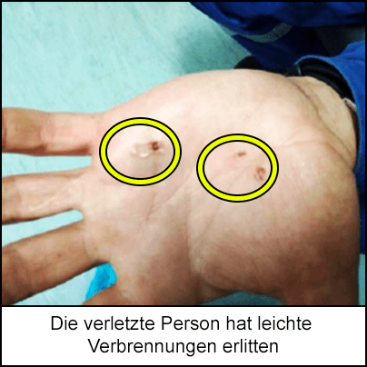 Die verletzte Person hat leichte Verbrennungen erlitten