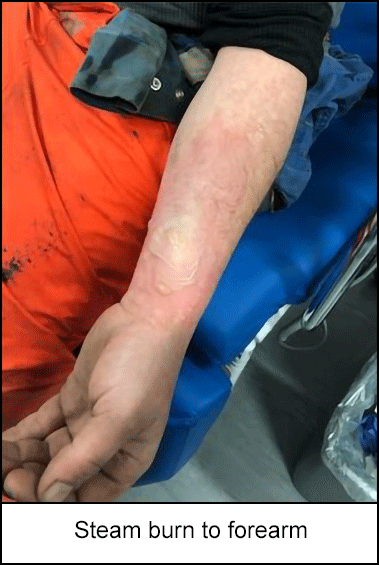 Steam burn to forearm 