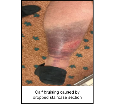 Calf bruising caused by dropped staircase section