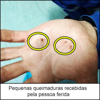 Pequenas queimaduras recebidas pela pessoa ferida