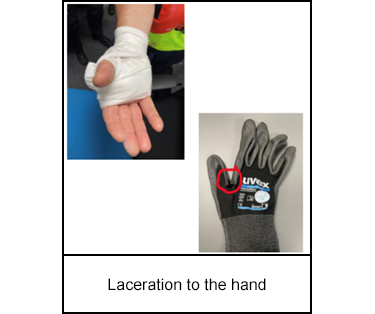Laceration to the hand
