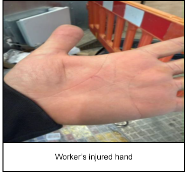 Worker’s injured hand