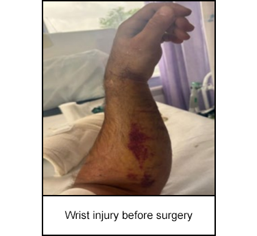 Wrist injury before surgery