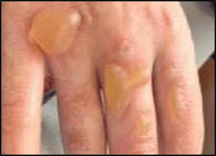 Queimaduras nas mãos causadas pela ignição do desinfetante