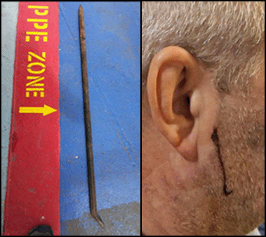 Pinch bar (left) and injured person showing lacerated cheek (right)