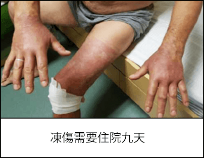一位雙手和一條腿都被凍傷的工人，凍傷的皮膚發紅，膝蓋周圍包紮繃帶 