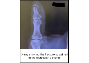 X-ray showing the fracture sustained to the technician’s thumb.